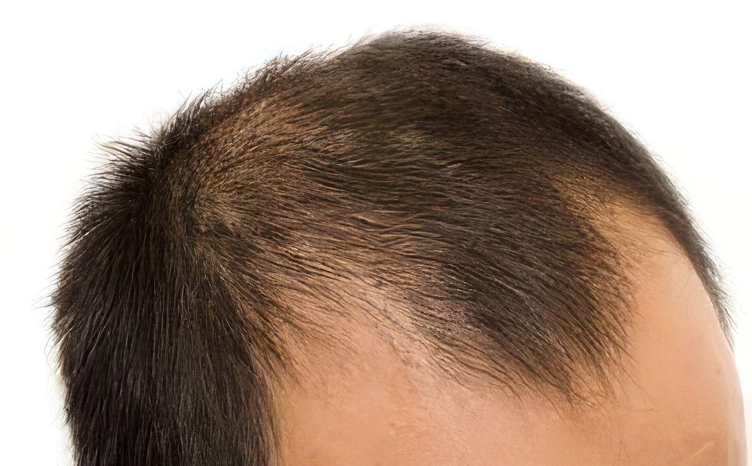 Alopecia Androgenetica