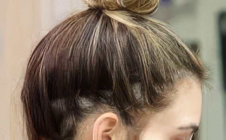 Traction Alopecia
